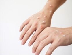 Dinkes Kepulauan Meranti Pastikan Tidak Ada Penambahan Kasus Cacar Monyet